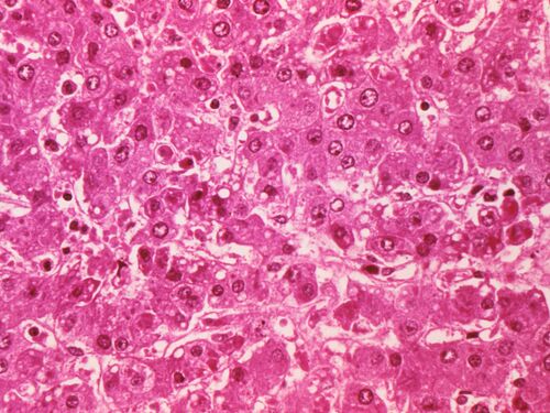 Light micrograph histologic section showing human liver infected with Ebola virus causing African Hemorrhagic Fever